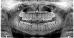 Co to jest rentgen stomatologiczny i jak wpływa na zdrowie zębów?